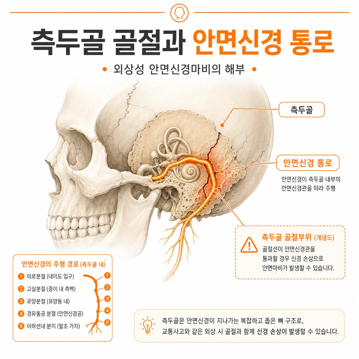 측두골 골절과 안면신경 통로 — 외상성 안면신경마비의 해부