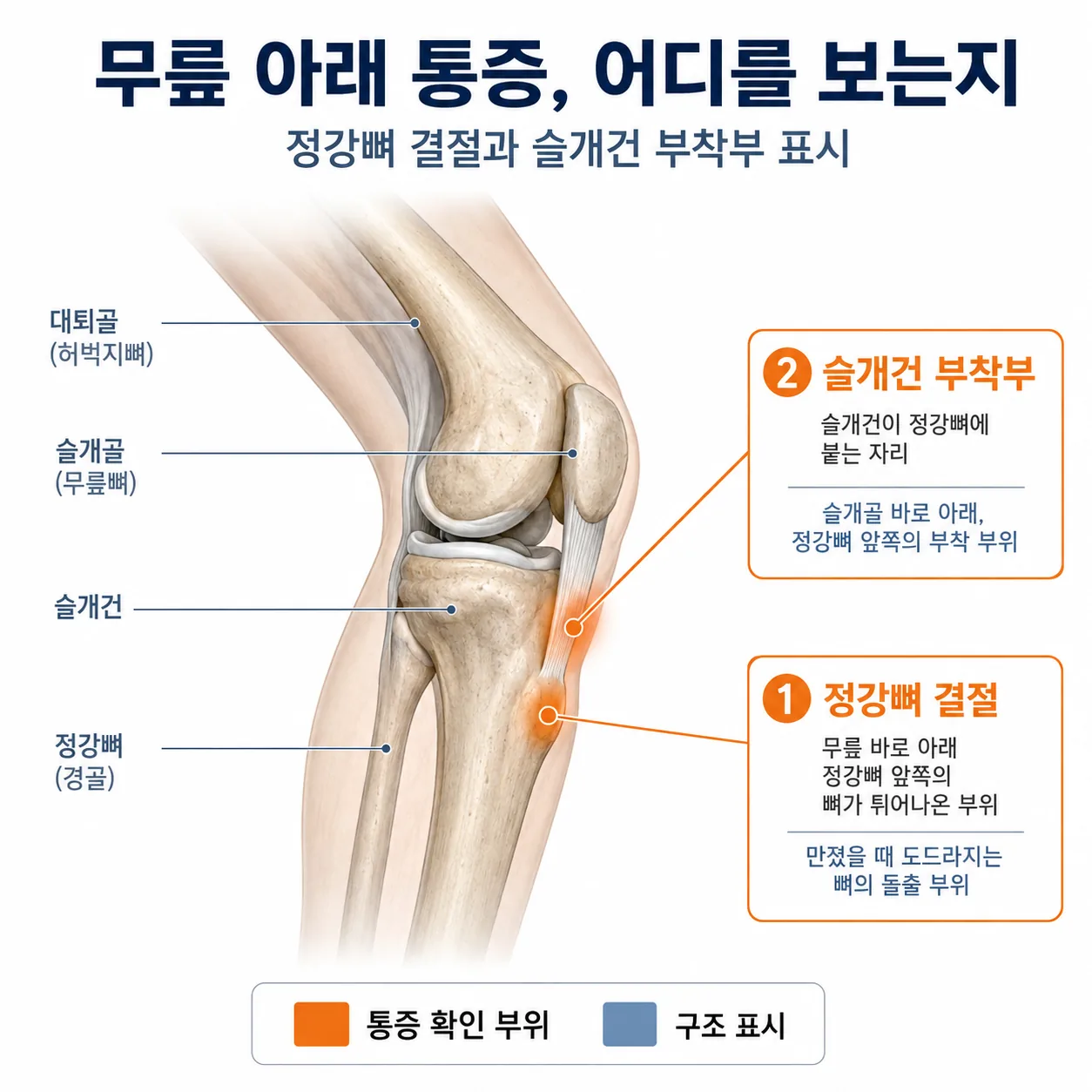 무릎 아래 정강뼈 결절과 슬개건 부착부를 표시한 그림