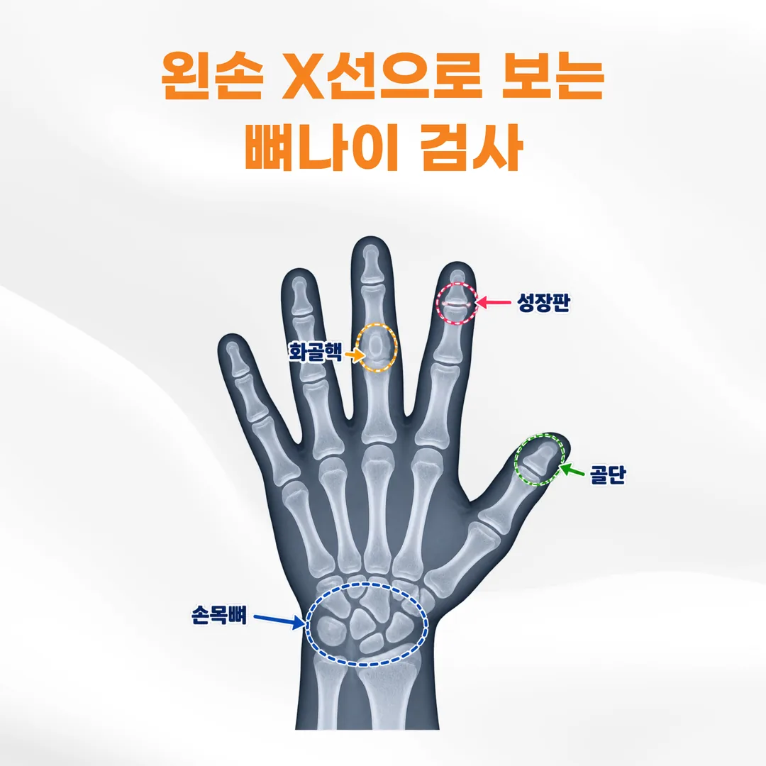 왼손 손목 방사선 사진으로 뼈나이를 판정하는 부위 개념도